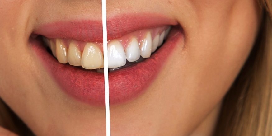 tent Tram appel 5 Tips voor wittere tanden - De Lieve Tandarts Nieuws