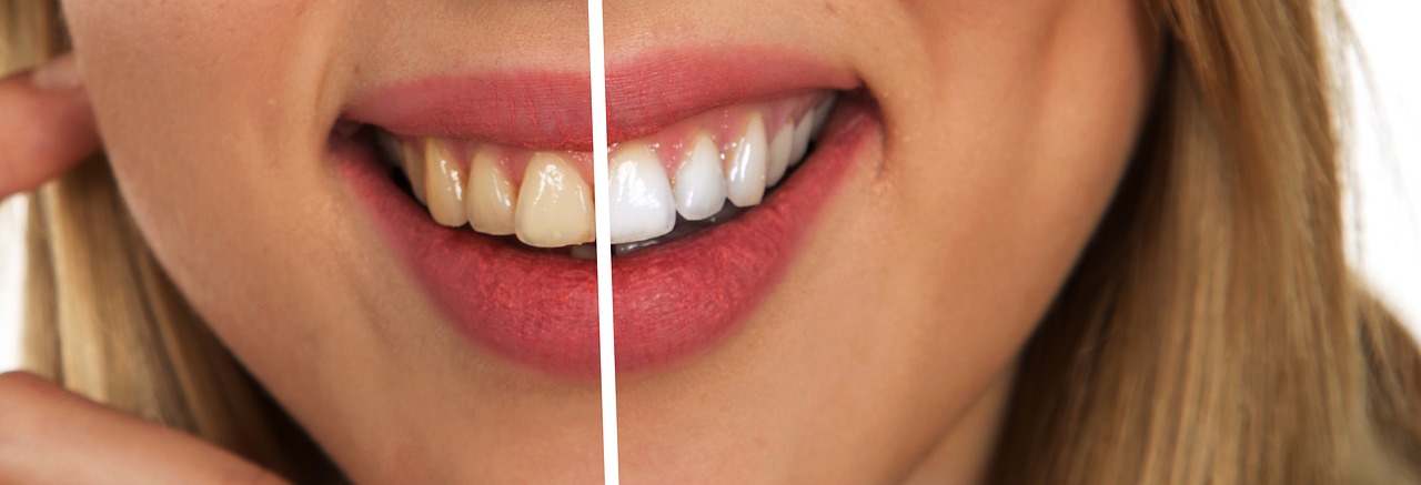 5 Tips voor wittere tanden - Lieve